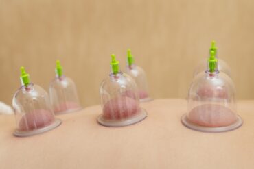 Acupuncture alleviate Perimenopause symptoms